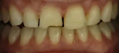 C.u. Upper Crowns 1 1