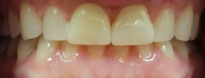 C.u. Upper Crowns 2 2