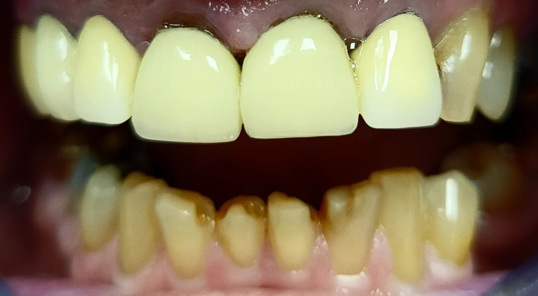J.o. Lower Resins And Upper Crown 1 2