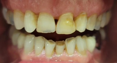 S.b. Full Anterior Reconstruction 1 2