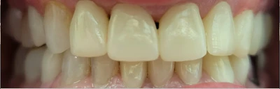 S.b. Full Anterior Reconstruction 2 1