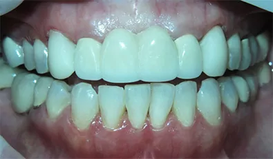 Smile1 After