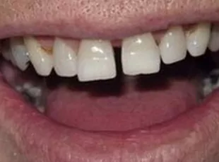 Smile2 Before