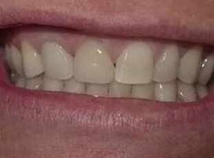 Smile3 After