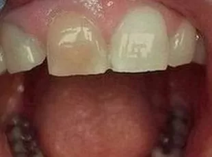 Smile3 Before
