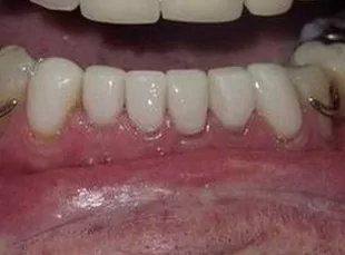 Smile4 After
