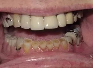 Smile4 Before
