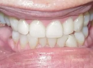 Smile7 After