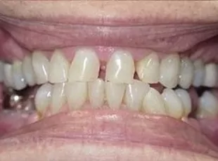 Smile7 Before
