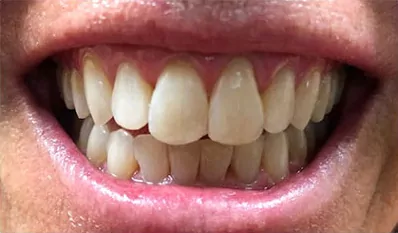 Smile8 After