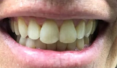 Smile8 Before