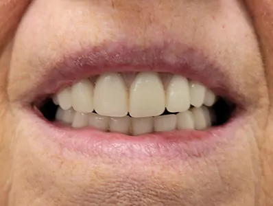 Smile9 After