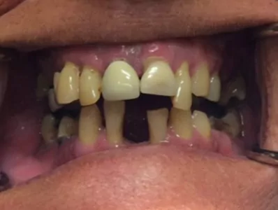 Smile9 Before